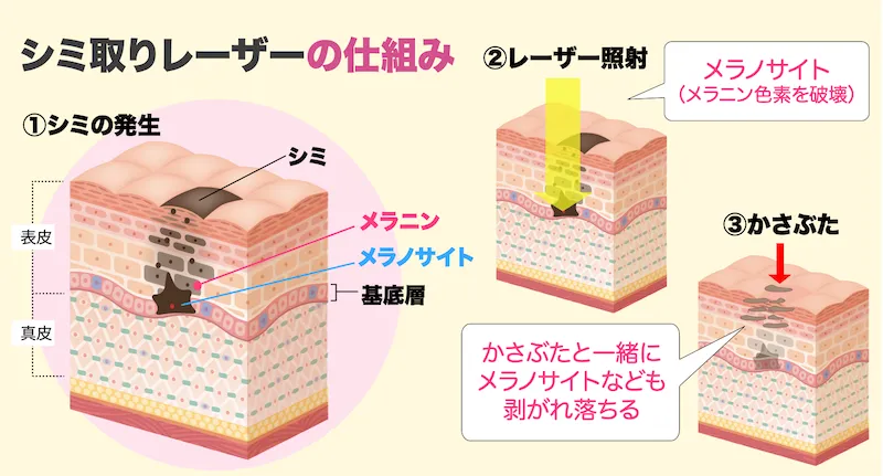 シミ取りレーザーの仕組み