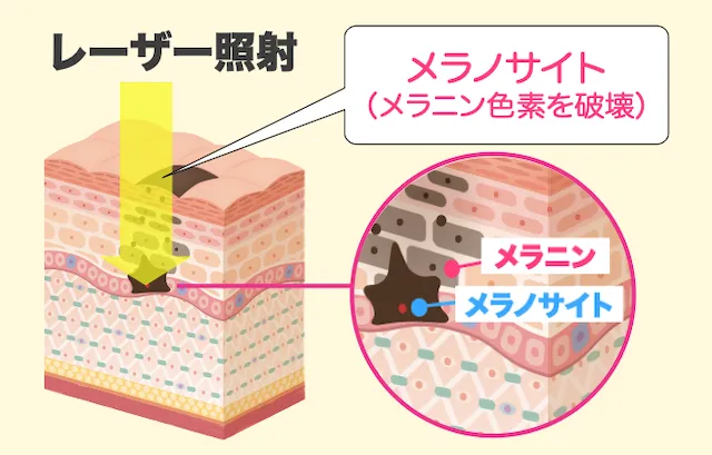 メラニン色素を破壊
