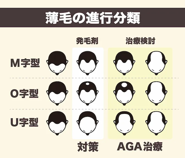発毛剤　薄毛分類