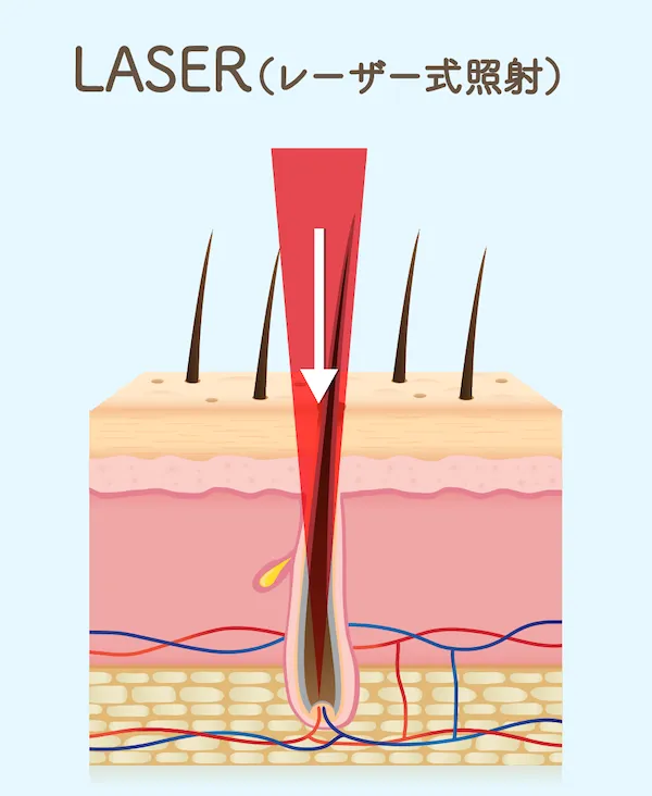 レーザー式脱毛器照射範囲図
