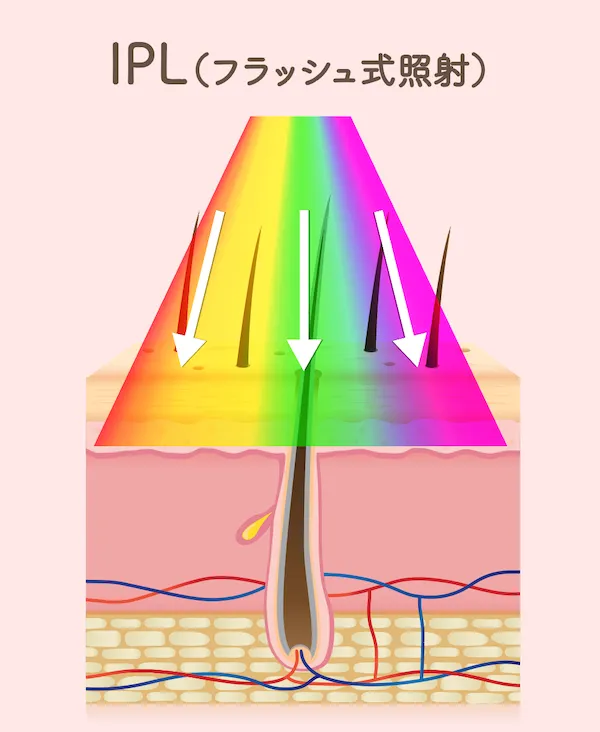 フラッシュ式脱毛器照射範囲図