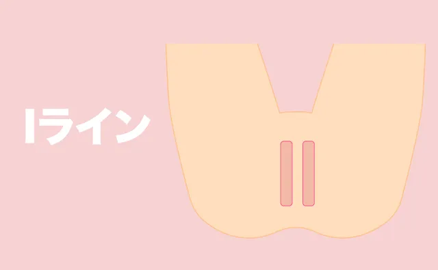 Iライン