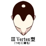 ⅢVertex型
